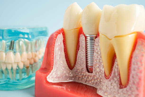 Best Dental Fillings (Composite and Amalgam)  in Geva, NE